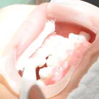 新見市のホワイトニング